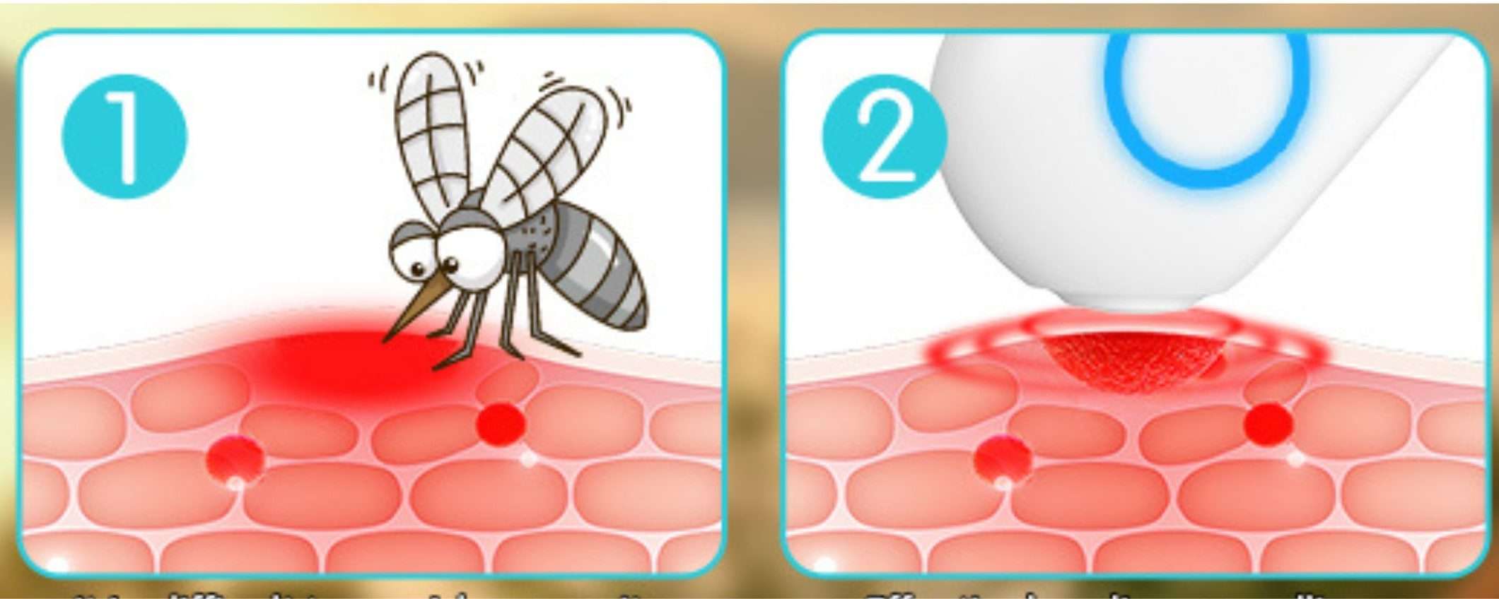 Puntura di zanzara SOLLIEVO immediato: dispositivo ricaricabile a 12€ (-50%)